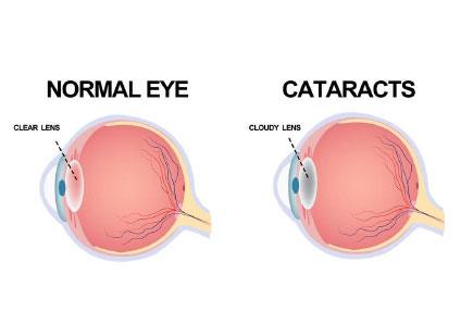 Technology in Cataract Surgery