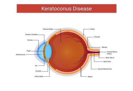 Understanding the Keratoconus