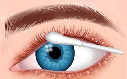 علاج التهاب الجفون في أحسن مستشفى لأمراض العيون في أبوظبي
